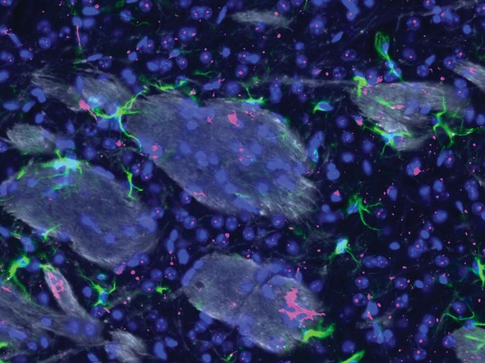 KS4 & KS5 biology: The molecular mechanisms behind Huntington’s disease