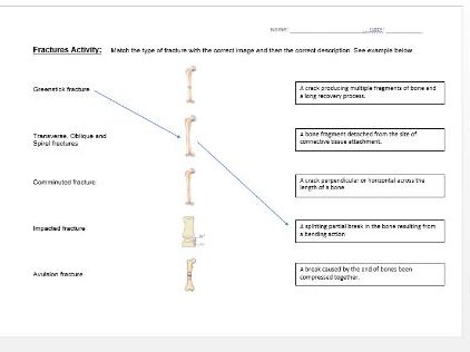 A-Level PE: Injuries -  Fractures Activity Sheet